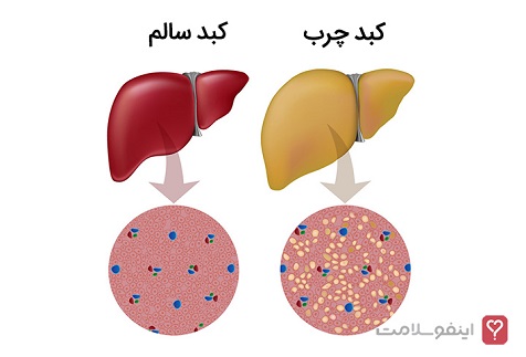 بیماری کبد چرب چیست؟/ عواملی که باعث ایجاد این نوع بیماری کبد چرب می‌شود