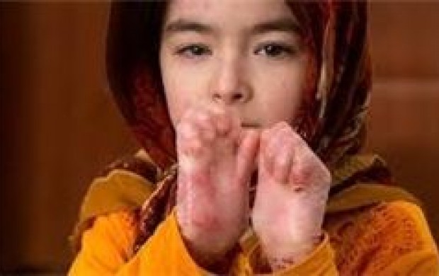 این کودک معصوم پروانه ای باید سریع عمل شود