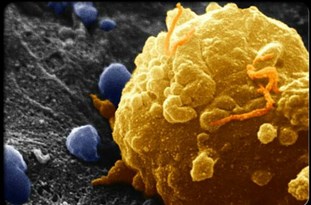 کمیته ملی کنترل سرطان در کشور تشکیل شد/ برنامه ثبت سرطان مبتنی بر جمعیت کلید خورد/ 50 درصد سرطان‎ها قابل پیشگیری است