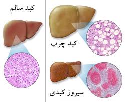 چه کسانی کبدشان چرب می شود؟ 