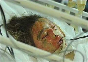 مرگ دلخراش خواهر و برادر خردسال بر اثر واژگونی دیگ آب جوش