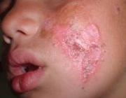 شيوع بيماري سالك در گلستان