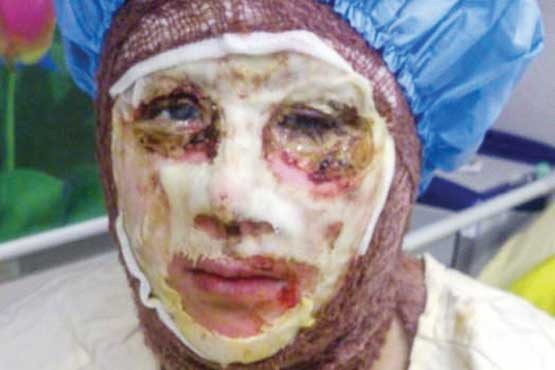 آخرین خبر از عامل اسیدپاشی اصفهان