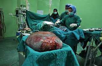 خارج شدن غده (کیست) 14 کیلوگرمی از شکم یک بیمار در بیمارستان امام خمینی (ره) بندرترکمن